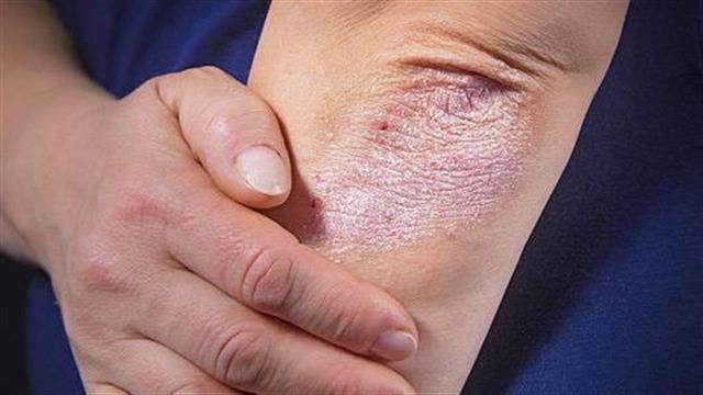 Ώρα να το ξεκαθαρίσουμε!- Εκστρατεία για την ψωρίαση